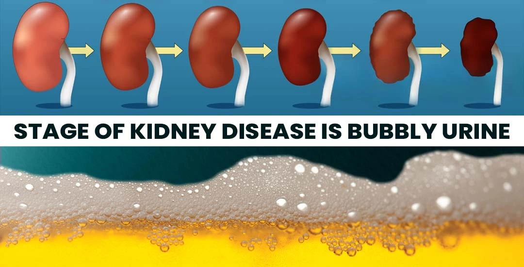 What Stage of Kidney Disease is Bubbly Urine?